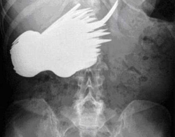 İnsanların vücudundan çıkan garip nesneler  G2