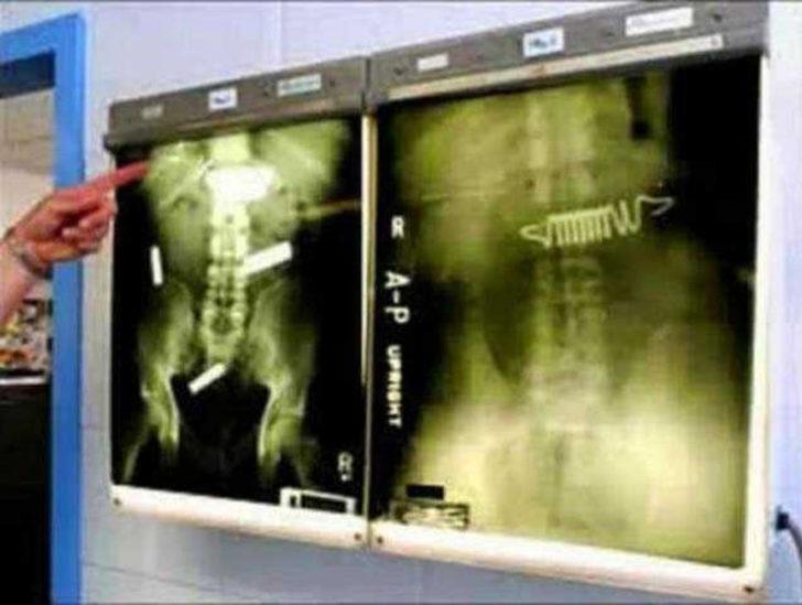 İnsanların vücudundan çıkan garip nesneler  G3