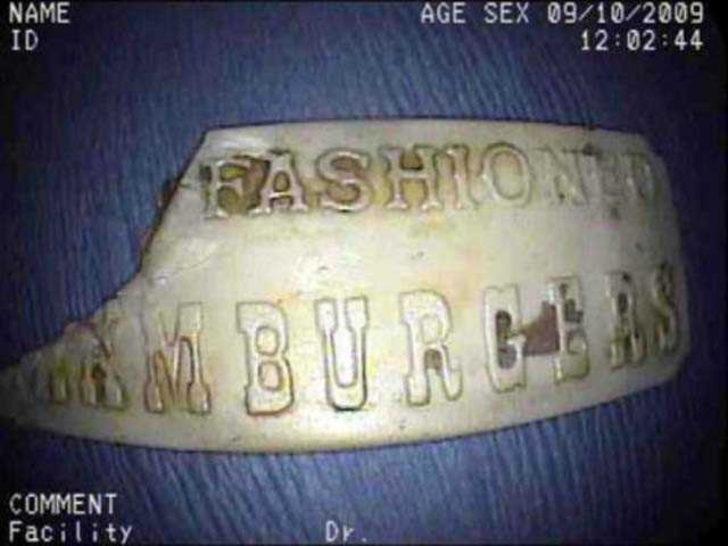 İnsanların vücudundan çıkan garip nesneler  G5