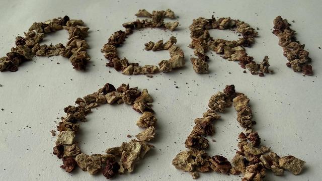 Daha önce 21 kez operasyon geçirdi: Böbreğinden 295 taş çıkarıldı!