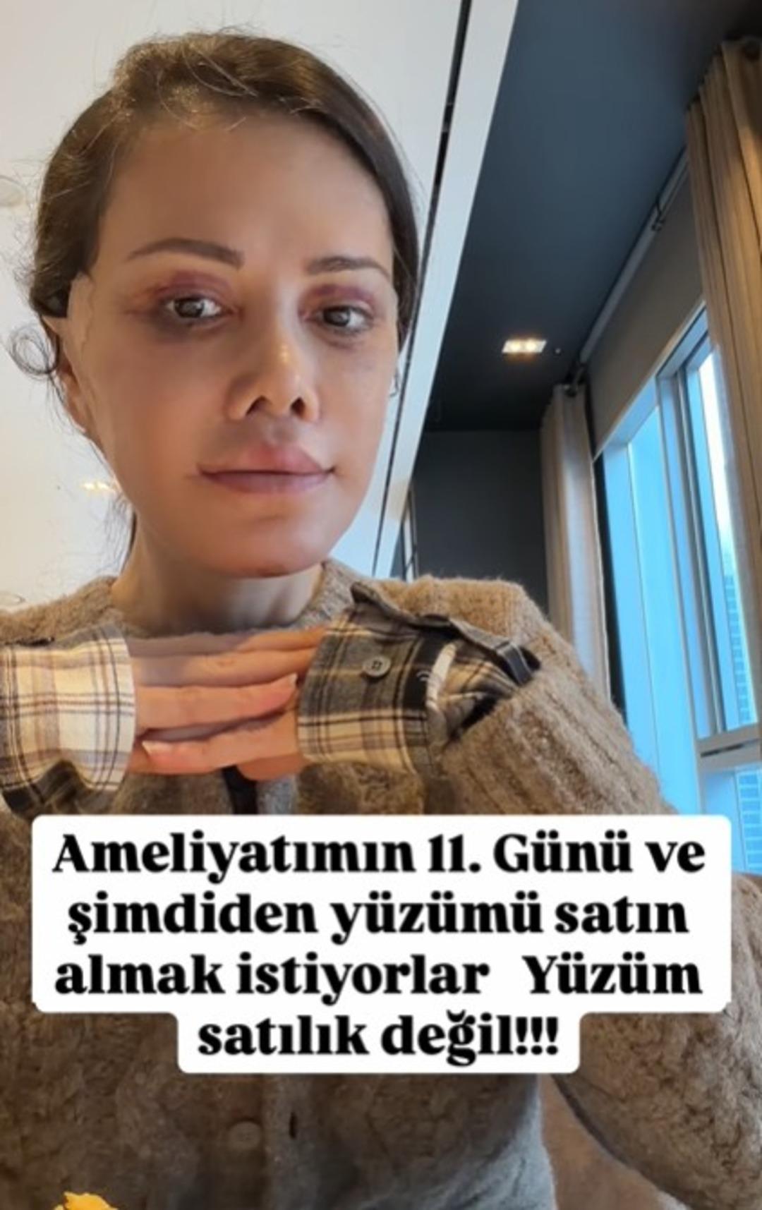 Eski Survivor yarışmacısı Didem Ceran y&uuml;z nakli yaptırdı! Operasyon tam iki g&uuml;n s&uuml;rd&uuml;   5