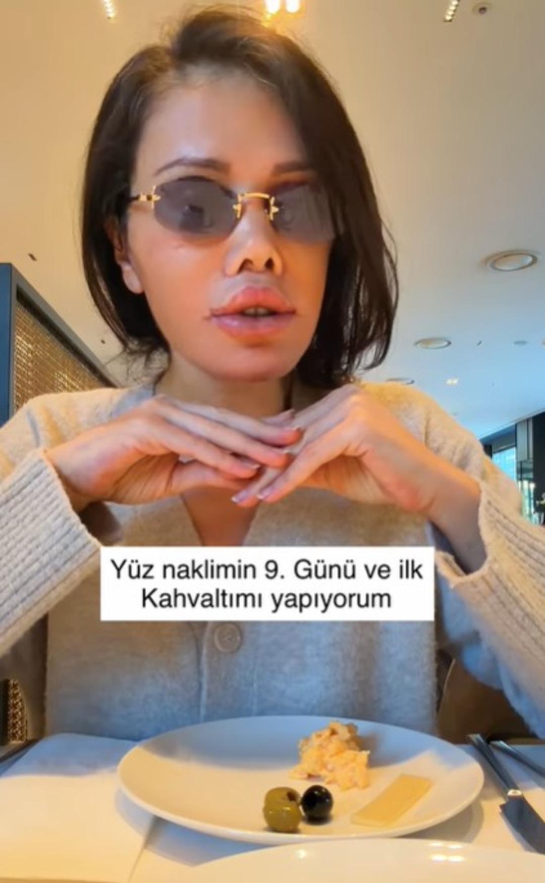Eski Survivor yarışmacısı Didem Ceran y&uuml;z nakli yaptırdı! Operasyon tam iki g&uuml;n s&uuml;rd&uuml;   4