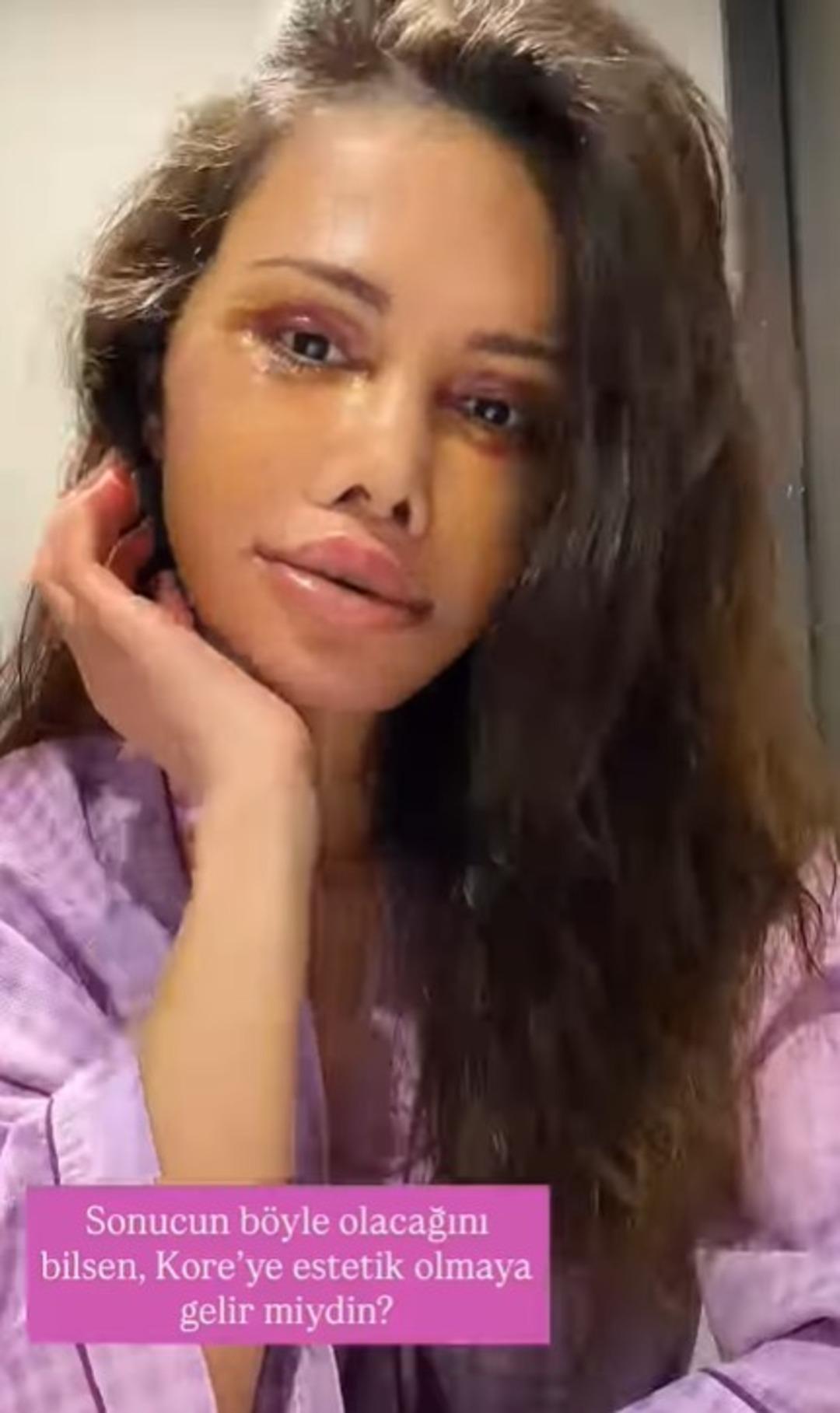 Eski Survivor yarışmacısı Didem Ceran y&uuml;z nakli yaptırdı! Operasyon tam iki g&uuml;n s&uuml;rd&uuml;   3