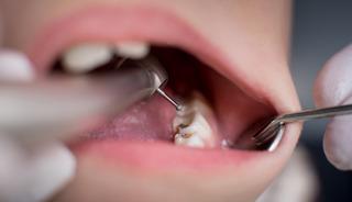 Dişlerinize i&ccedil;ten i&ccedil;e zarar veriyor! İşte 3 tehlikeli belirti