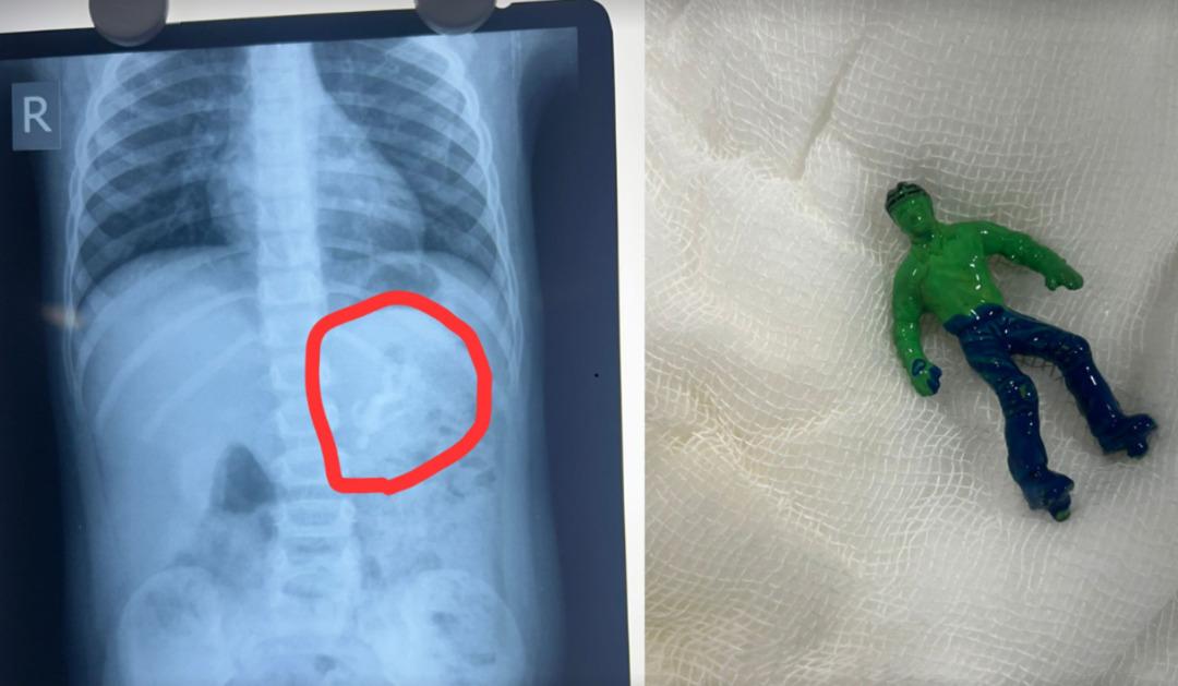 1,5 yaşındaki çocuğun midesinden hulk oyuncağı çıktı! Nasıl yuttuğuna doktorlar bile inanamadı 1