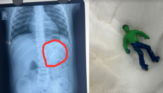 1,5 yaşındaki &ccedil;ocuğun midesinden 'hulk' oyuncağı &ccedil;ıktı! Nasıl yuttuğuna doktorlar bile inanamadı