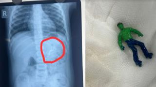 1,5 yaşındaki çocuğun midesinden 'hulk' oyuncağı çıktı! Nasıl yuttuğuna doktorlar bile inanamadı