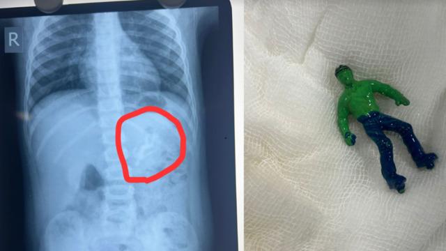 1,5 yaşındaki çocuğun midesinden 'hulk' oyuncağı çıktı! Nasıl yuttuğuna doktorlar bile inanamadı