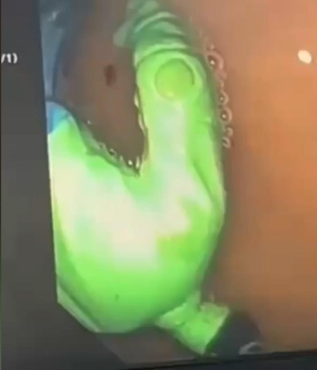 1,5 yaşındaki çocuğun midesinden hulk oyuncağı çıktı! Nasıl yuttuğuna doktorlar bile inanamadı 2