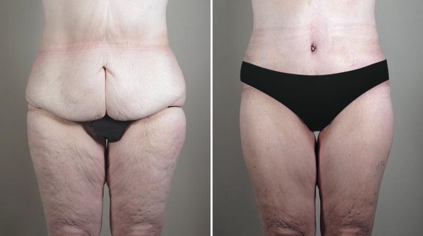 Post Bariatrik ameliyatlarıyla yeni bir sen