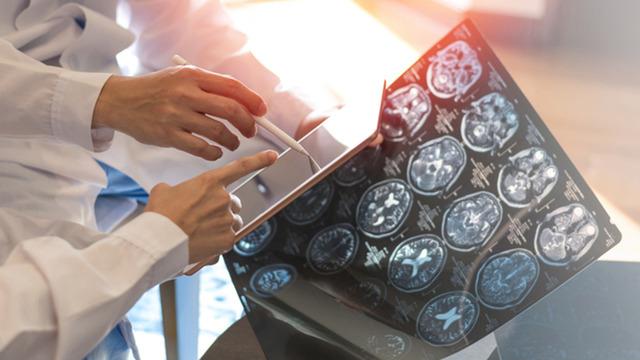 Demansın en sinsi belirtisi öğlen ortaya çıkıyor! Bu hissi yaşayanlar dikkat 