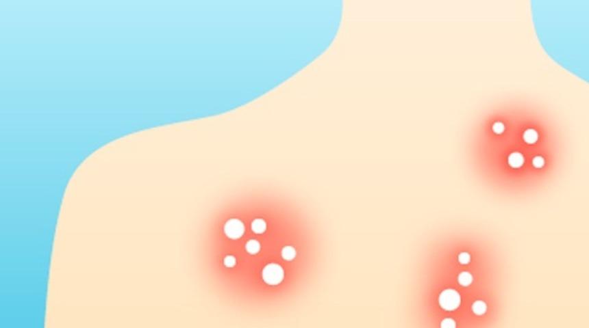 ‘Köpek memesi’ hastalığında kadınlar risk altında