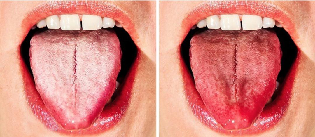 Dildeki beyazlık hastalık habercisi olabilir