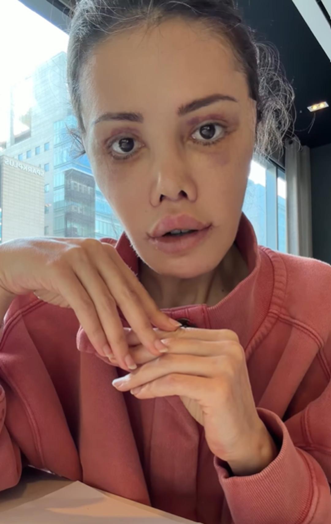 Didem Ceran, &ldquo;Y&uuml;z naklimin 16. g&uuml;n&uuml;&rdquo; diyerek son halini paylaştı 1