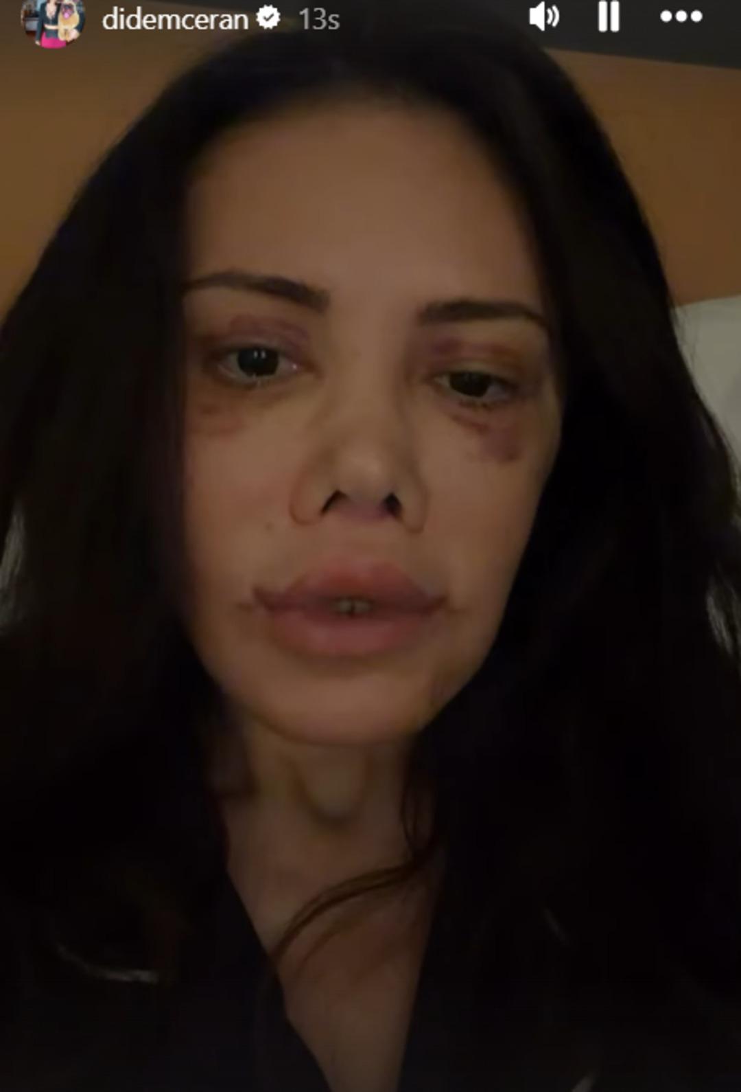 Didem Ceran, &ldquo;Y&uuml;z naklimin 16. g&uuml;n&uuml;&rdquo; diyerek son halini paylaştı 2