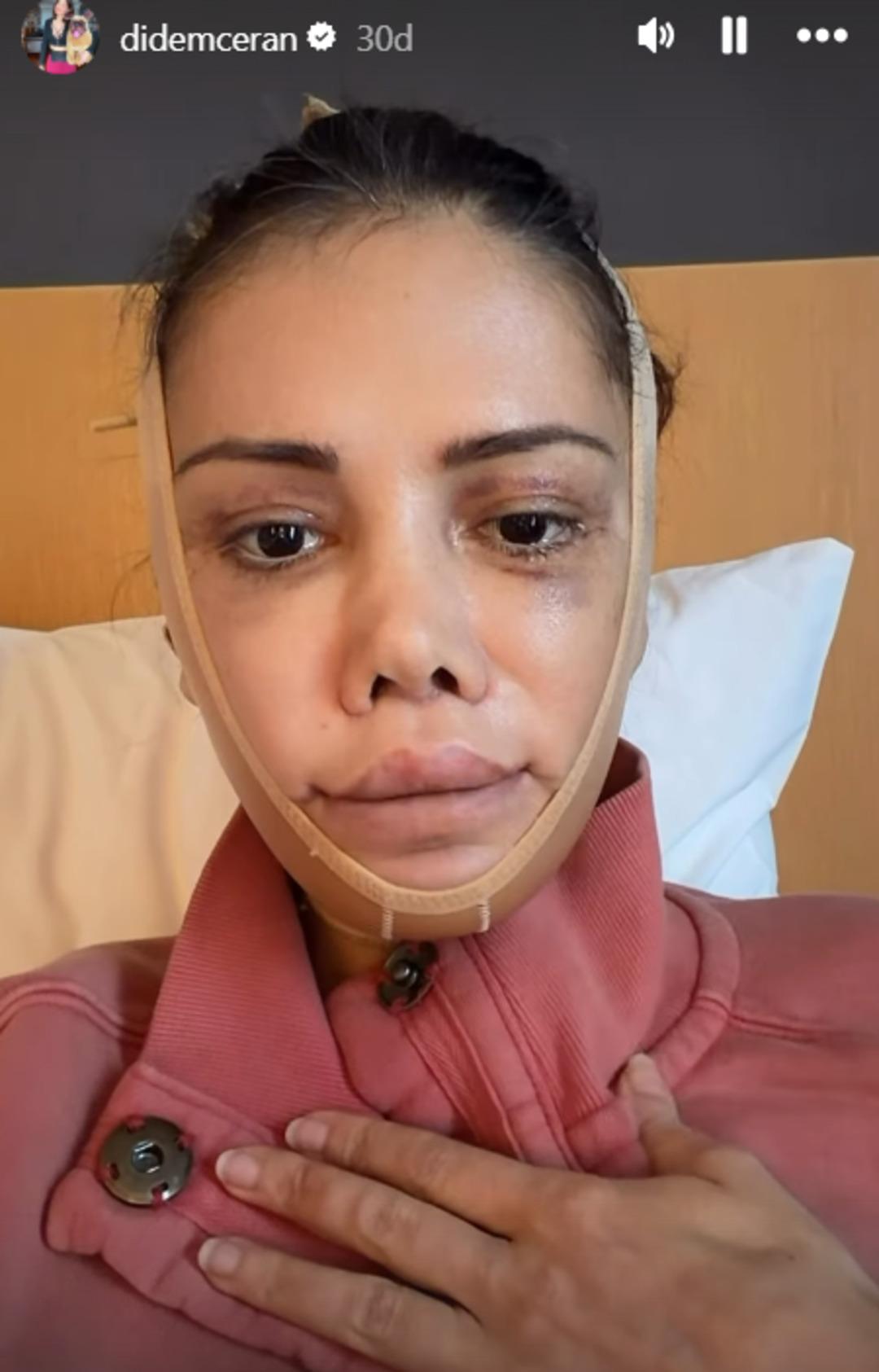 Didem Ceran, &ldquo;Y&uuml;z naklimin 16. g&uuml;n&uuml;&rdquo; diyerek son halini paylaştı 3