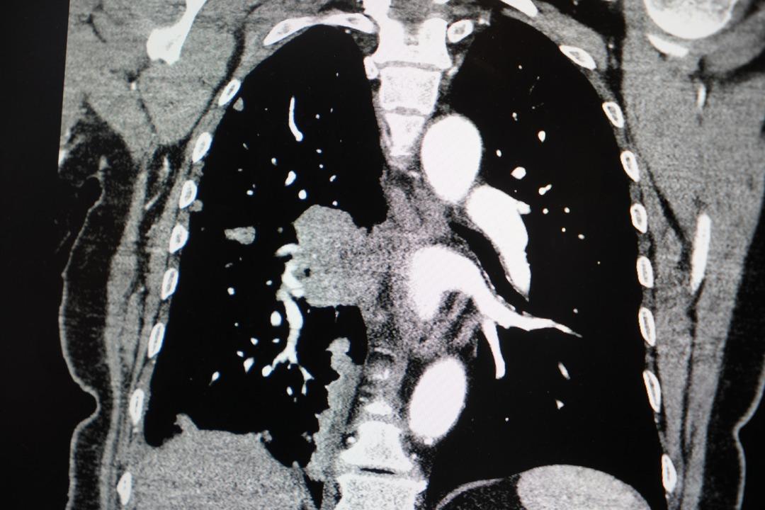  Rekor seviye  Profes&ouml;rden korkutan uyarı: Son 10 yılda y&uuml;zde 38 arttı!  1