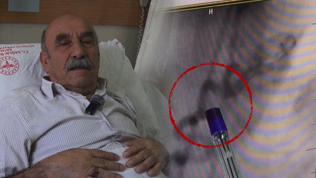 Göğüs yanması sandı, kalbinden kan 'çalan' damar bulundu!