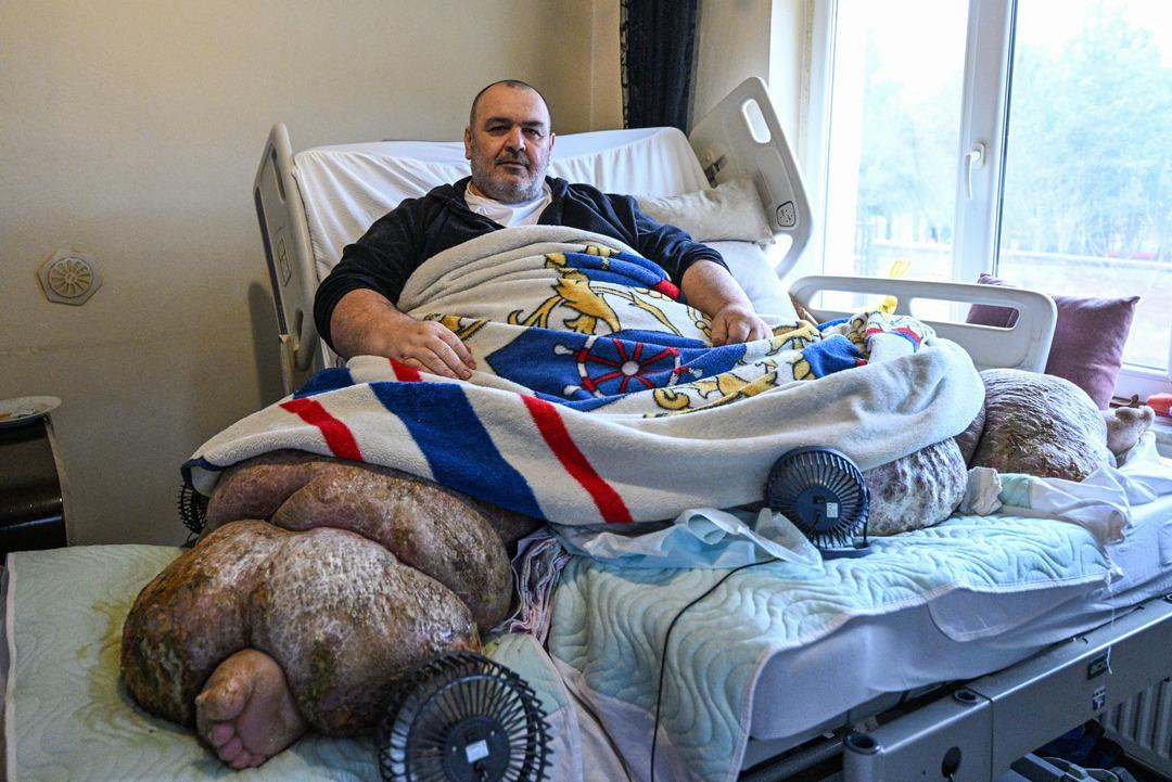 300 kiloya ulaşan fil hastası sevk edildi: Kapılar kırıldı, &ouml;zel ekiple Ankara ya g&ouml;nderildi 4