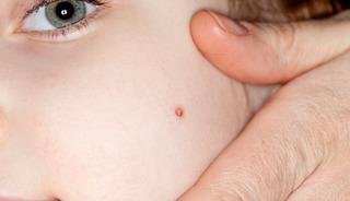 &Ccedil;ocuklarda hangi benler masum hangileri tehlike taşıyor?