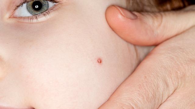 Çocuklarda hangi benler masum hangileri tehlike taşıyor?