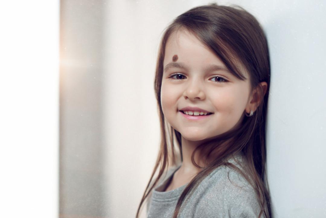 Çocuklarda hangi benler masum hangileri tehlike taşıyor? 3