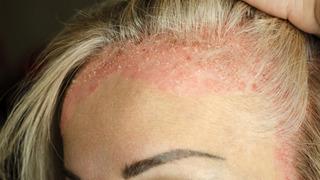 Son dakika: Kaşıdık&ccedil;a artan tehlike: Soğuk hava egzamayı tetikliyor mu?