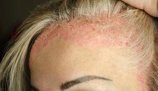 Kaşıdık&ccedil;a artan tehlike: Soğuk hava tetikliyor mu?