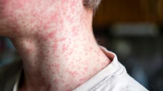 Son dakika: Kızamık salgını başkenti alarma ge&ccedil;irdi: 7 okul harekete ge&ccedil;ti! 60 &ccedil;ocuğa bulaştı