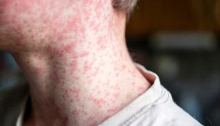 Başkentte alarm: 7 okul harekete ge&ccedil;ti! 60 &ccedil;ocuğa bulaştı