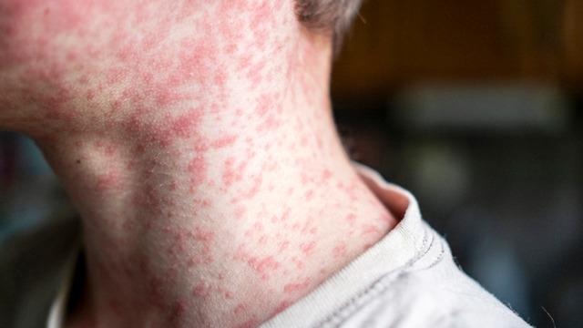 Kızamık salgını başkenti alarma geçirdi: 7 okul harekete geçti! 60 çocuğa bulaştı