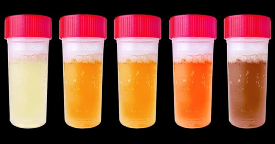 İdrar rengi sağlığınız hakkında &ouml;nemli bilgiler veriyor