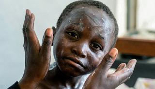 Cezaevinde Mpox &ouml;l&uuml;m&uuml;! Yeni varyant ortaya &ccedil;ıktı