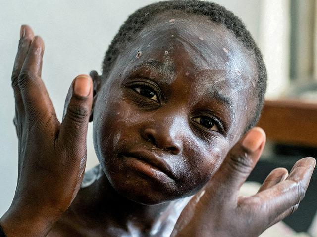 Cezaevinde Mpox &ouml;l&uuml;m&uuml;! Yeni varyant ortaya &ccedil;ıktı