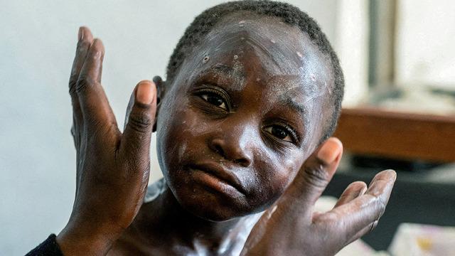 Cezaevinde Mpox ölümü! Yeni varyant ortaya çıktı: Hızla yayılıyor