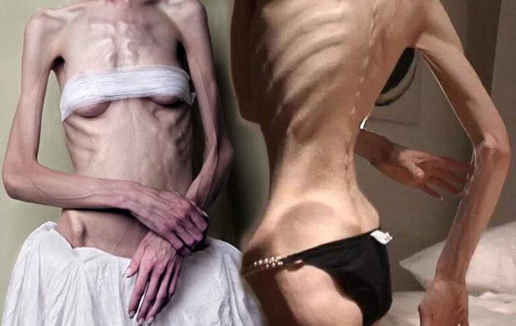  Obeziteden g&uuml;n&uuml;m&uuml;z hastalığı Ortoreksiya'ya nasıl geldik? 