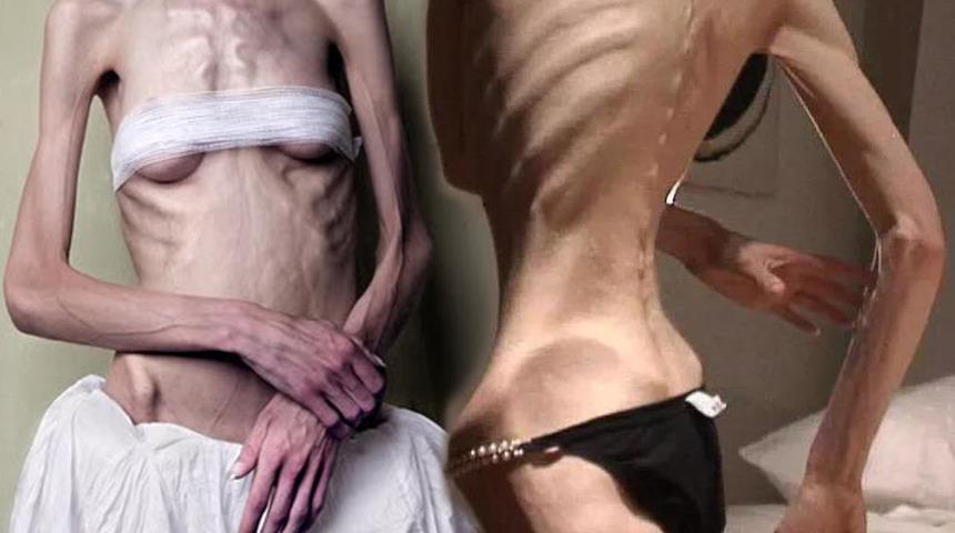  Obeziteden g&uuml;n&uuml;m&uuml;z hastalığı Ortoreksiya'ya nasıl geldik? 