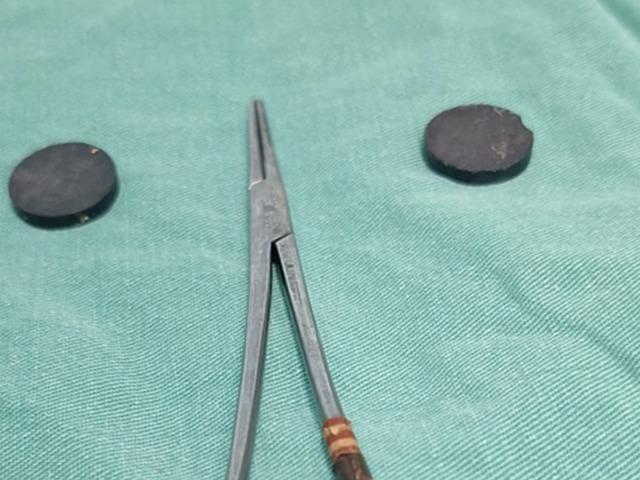 4 yaşındaki &ccedil;ocuğun bağırsaklarından &ccedil;ıkana inanamayacaksınız