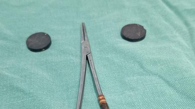 Çekilen röntgen filmi herkesi şaşırttı! 4 yaşındaki çocuğun bağırsaklarından çıkana inanamayacaksınız