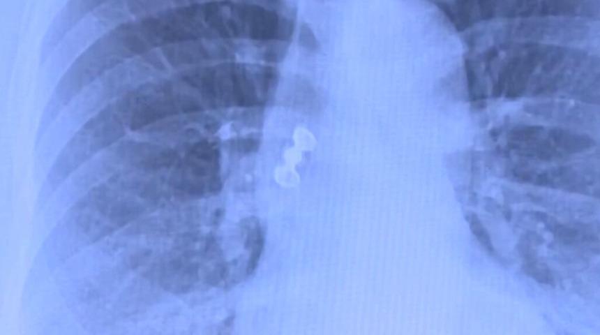 Sabah uyandı, dişleri yoktu! R&ouml;ntgeni g&ouml;ren doktorlar şok oldu