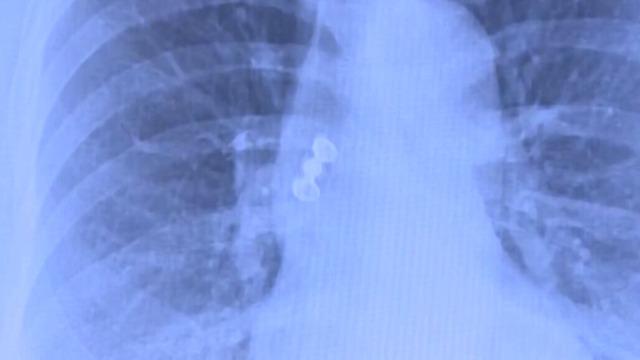 Sabah uyandı, dişleri yoktu! Röntgeni gören doktorlar şok oldu