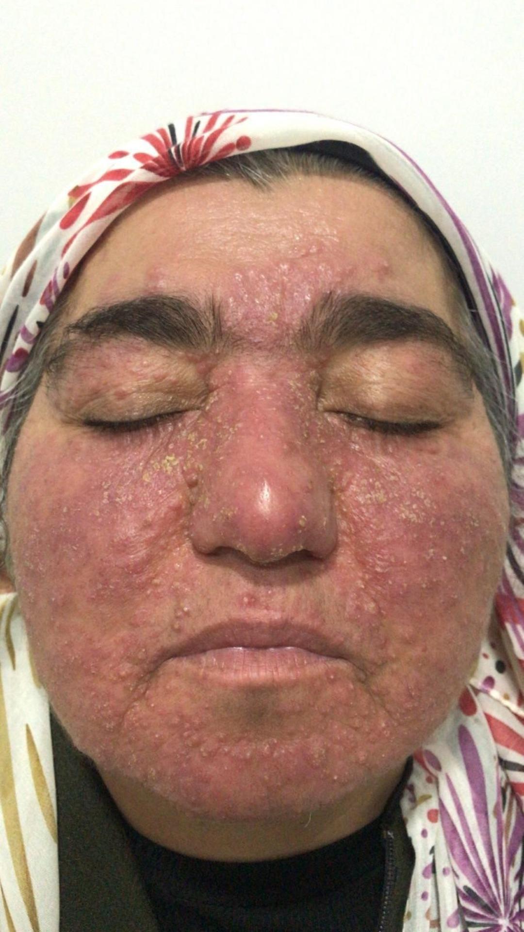 Yıllarca evden çıkmadı: Oğlunun düğününe bile gidemedi! Tedaviyle hayatı değişti 5