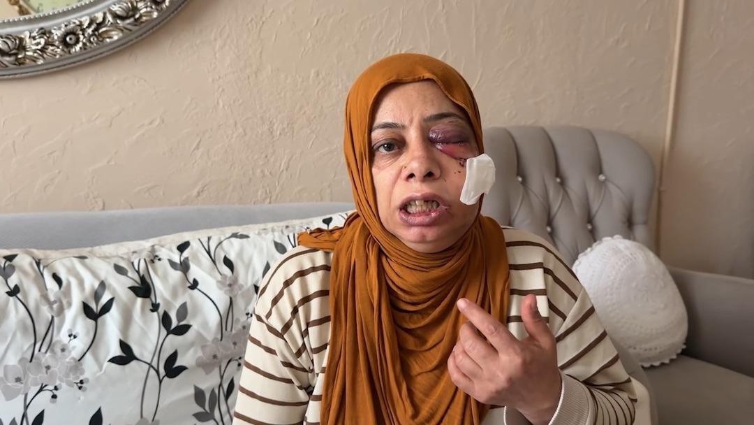 Elektrikli bisikletle r&ouml;gara d&uuml;şt&uuml;! Tanınmayacak hale geldi 2