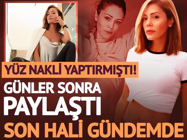 Eski Survivor yarışmacısı Didem Ceran y&uuml;z naklinden g&uuml;nler sonra paylaştı: 21. g&uuml;n! Son haline yorum yağdı