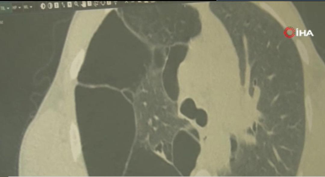 Ge&ccedil;meyen &ouml;ks&uuml;r&uuml;k hayatını değiştirdi! 30 yaşındaki Mahir nadir g&ouml;r&uuml;len MEN2 sendromu &ccedil;ıktı 1