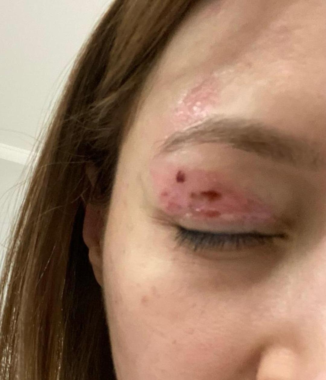 G&uuml;zellik salonunda 1000 liralık işlem yaptırdı: G&ouml;z&uuml;nde kalıcı hasar oluştu! 8