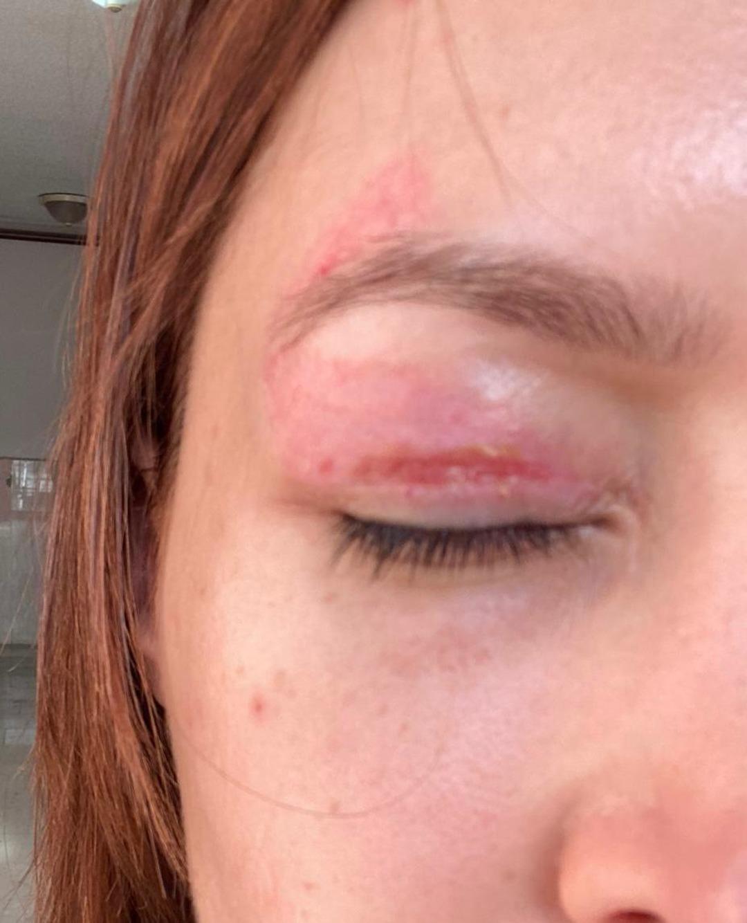 G&uuml;zellik salonunda 1000 liralık işlem yaptırdı: G&ouml;z&uuml;nde kalıcı hasar oluştu! 4