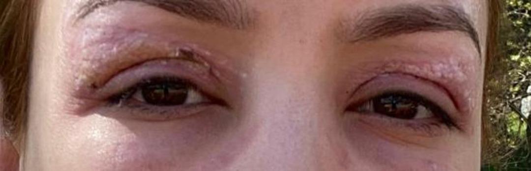 G&uuml;zellik salonunda 1000 liralık işlem yaptırdı: G&ouml;z&uuml;nde kalıcı hasar oluştu! 2