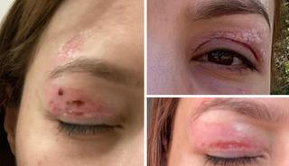 G&uuml;zellik salonunda işlem yaptırdı: G&ouml;z&uuml;nde kalıcı hasar oluştu!