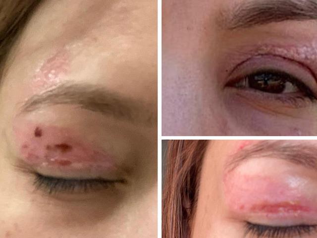 G&uuml;zellik salonunda işlem yaptırdı: G&ouml;z&uuml;nde kalıcı hasar oluştu!